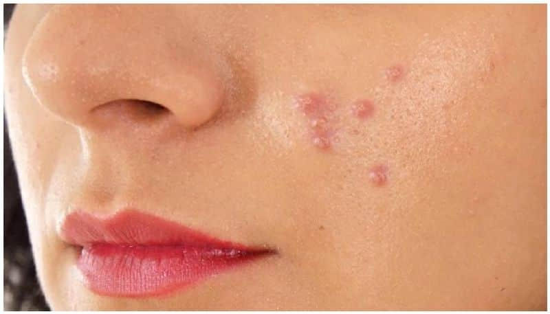 What To Do To Clear Pimple Scars: Here Are Simple Tips!