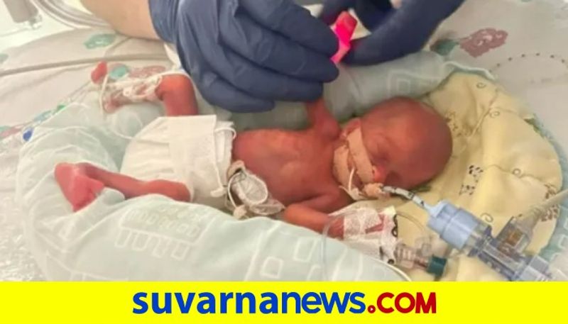 A teenager gave birth to a premature baby newborn weighed 325 grams akb