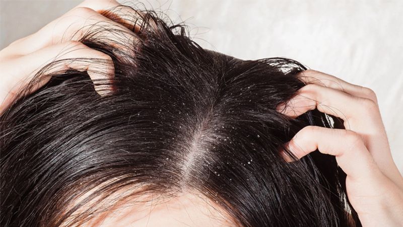 Dandruff and hair loss? Here are some amazingly simple tips!