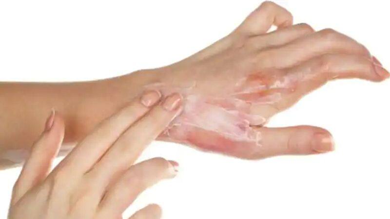 ways to heal your burns naturally at home ram