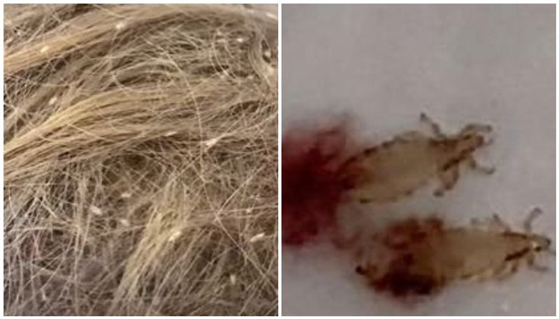 Hairdresser shares horrific lice infestation on girls head covered bites