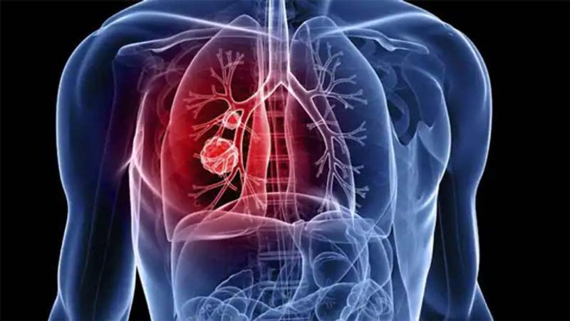 lung cancer symptoms you shouldnt ignore