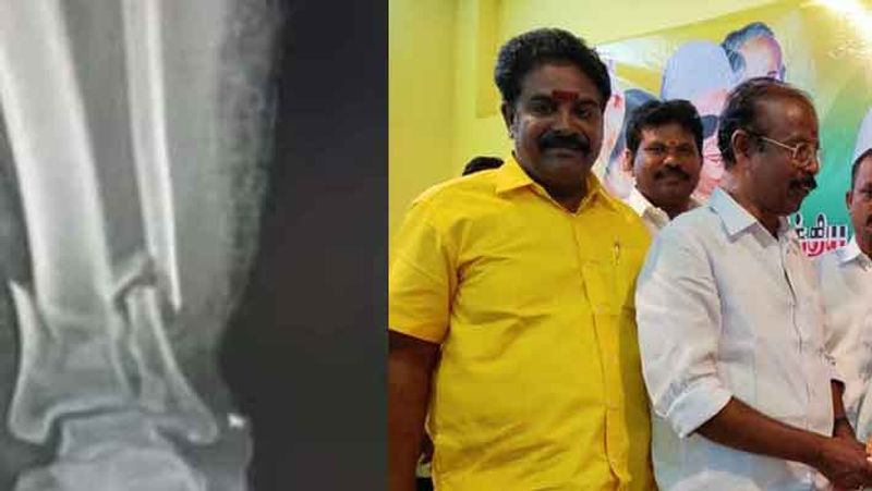 controversy speech... sattur aiadmk union secretary fracture