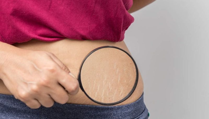 How to prevent stretch marks during pregnancy