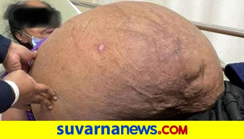 Ahmedabad Doctors remove 47 kg tumour from Gujarat womans stomach akb