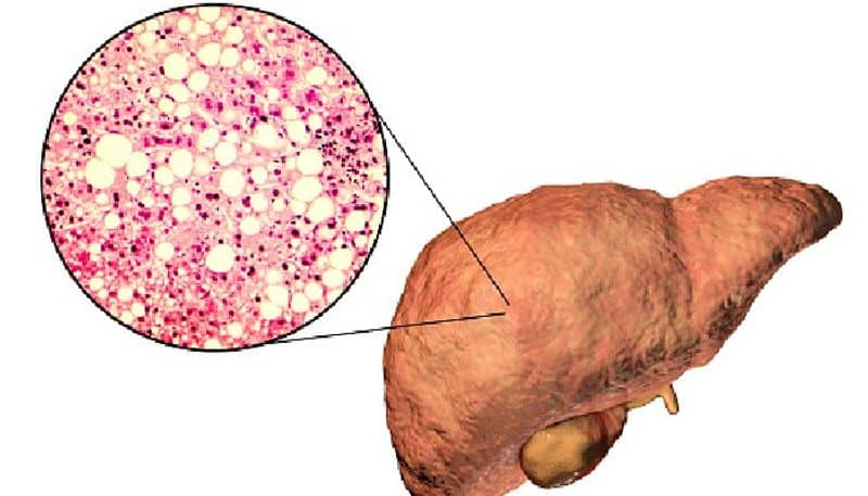 Do you have fatty liver? Know how this disease may result in insulin resistance RBA