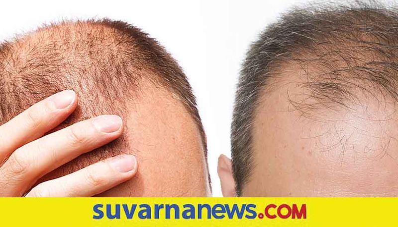 What is the most common cause of alopecia