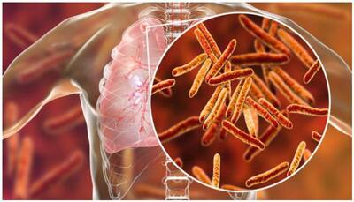 World Tuberculosis Day 2022: Significance, history, quotes, messages to spread awareness