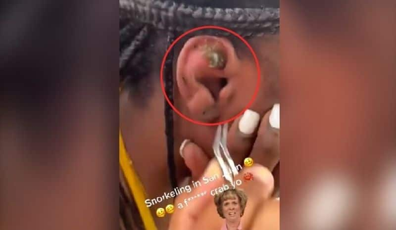 crab stuck on womens ear and video gone viral