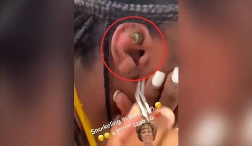 Viral Video: మహిళ చెవిలోకి వెళ్లిన పీత.. ఎలా బయటకు వచ్చిందంటే.. వైరలవుతున్న వీడియో ! 