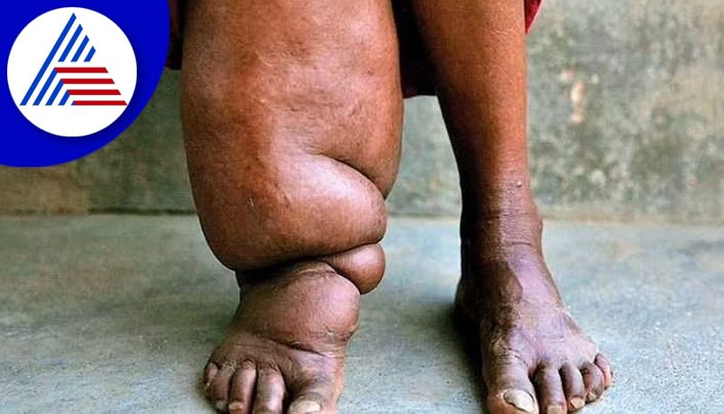 Elephantiasis Free District Uttara Kannada gvd