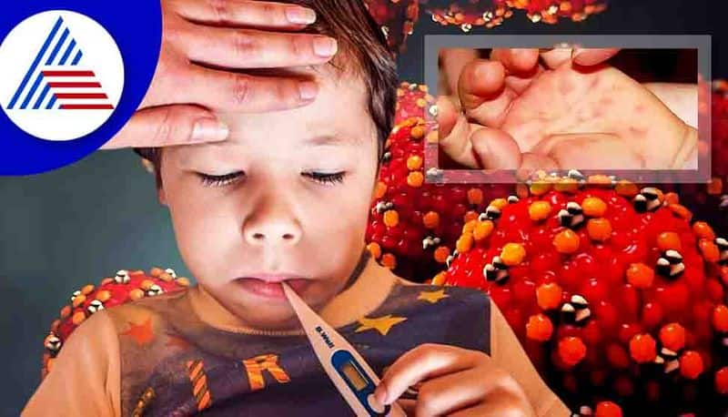 Tomato flu not detected in Udupi gow