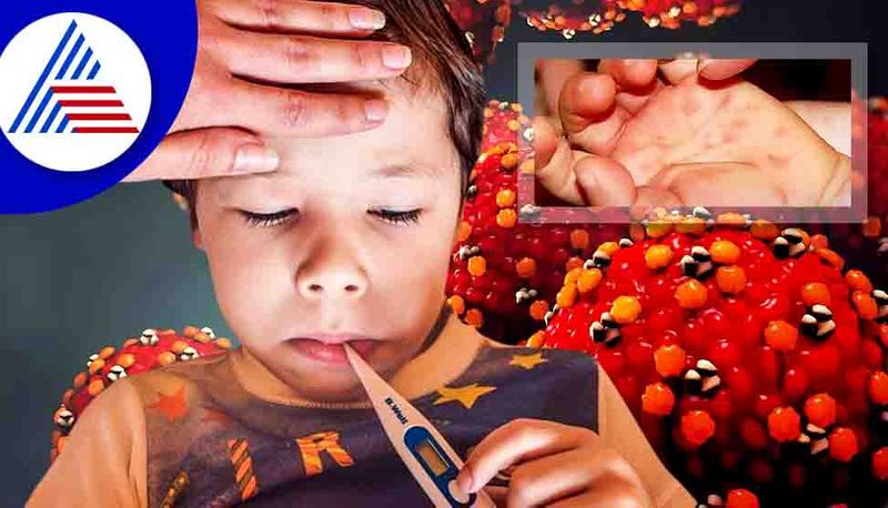 Tomato flu not detected in Udupi gow