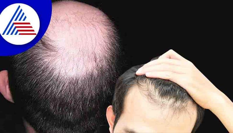 Hair Transplant Surgeon Tells Cause Of Hair Loss Tips To Maintain A Healthy Lifestyle