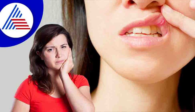 How to treat to cyst in internal mouth with home medicines sum