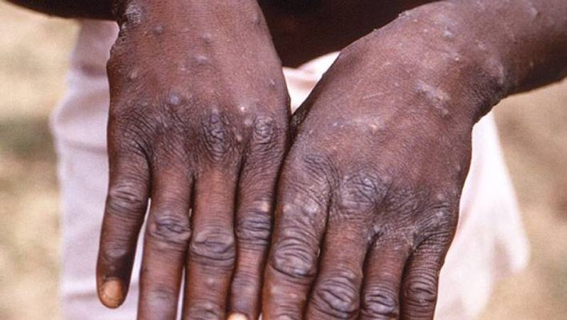 US Confirms 1st Case Of Monkeypox - Man Who Recently Travelled To Canada