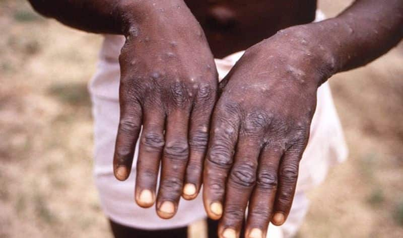 United Arab Emirates Reports First Known Monkeypox Case