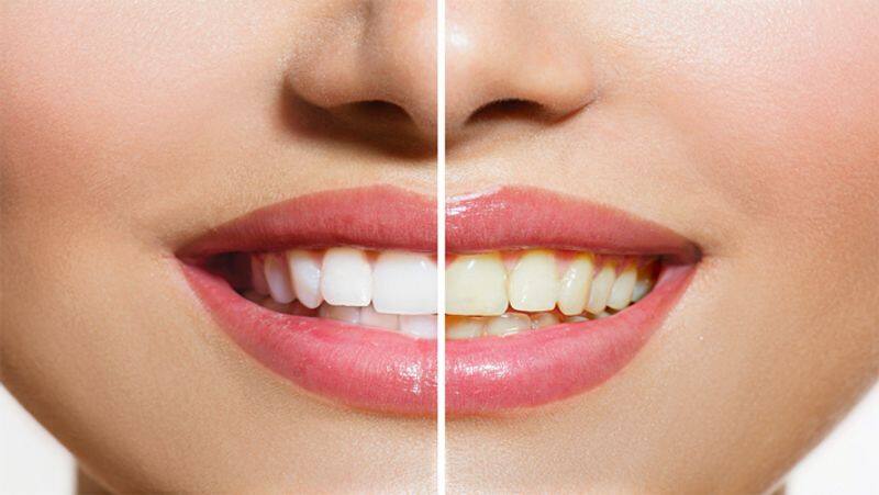 Home Remedies tips for yellow Teeth Whitening