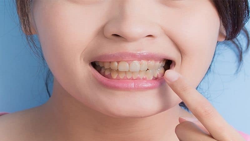 top 5 ayurvedic home remedies to remove yellow stains from teeth in tamil mks