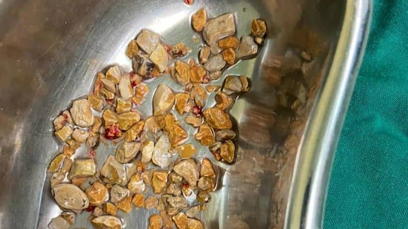 hyderabad Doctors remove 206 kidney stones in 1 hour