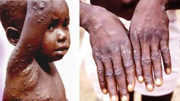 mpox virus outbreak in africa symptoms prevention treatment 