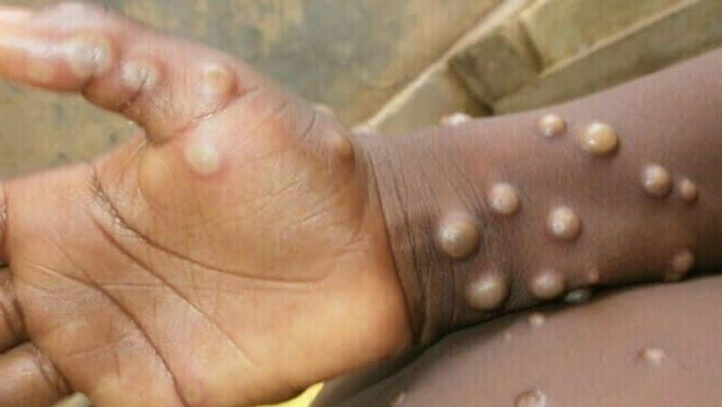 first monkeypox case found in UAE