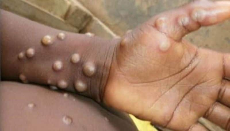 ICMR says No need to panic over monkeypox 