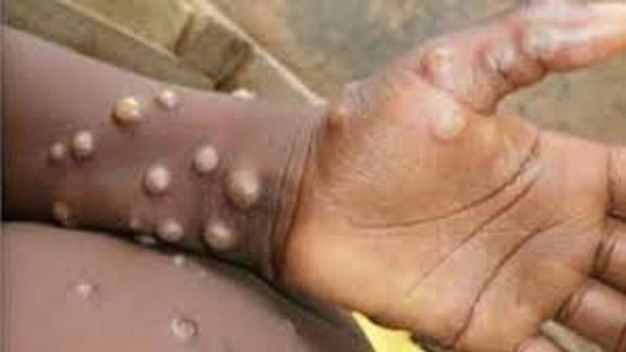 India's first Monkeypox case confirmed, Centre steps up surveillance; know about all about virus