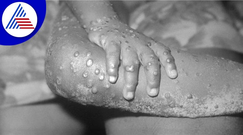 38 year old man in Kerala Malappram confirmed  monkeypox  India 2nd Mpox case san