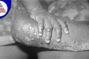 38 year old man in Kerala Malappram confirmed  monkeypox  India 2nd Mpox case san