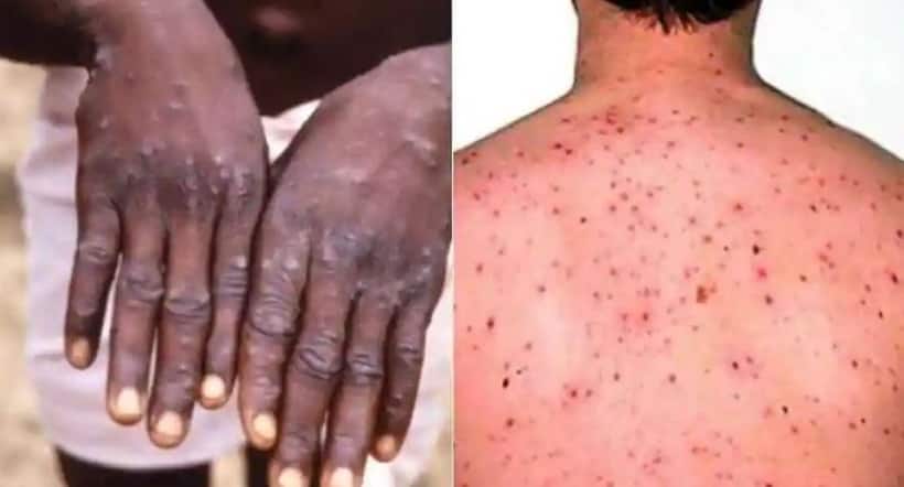 Monkeypox: WHO releases five critical measures to prevent the spread of infection 