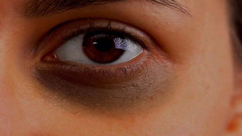 Home remedies to Remove Dark Circles in Tamil 