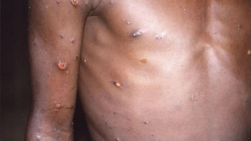 san francisco first major us city to declare monkeypox local emergency