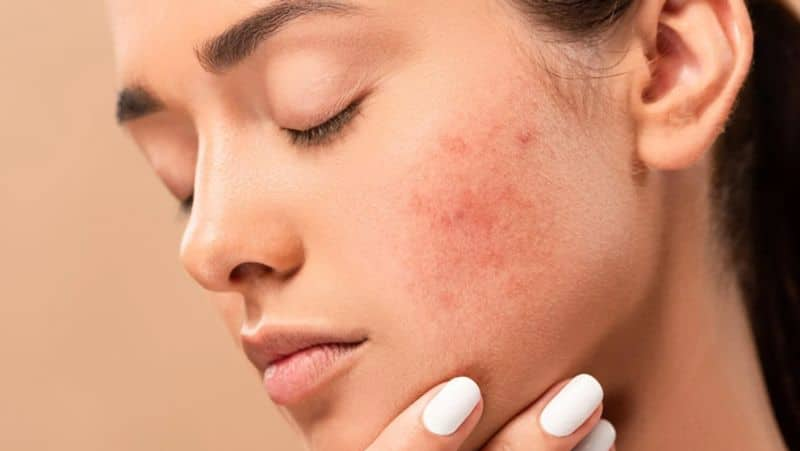 do you know what acne tells about your health in tamil mks