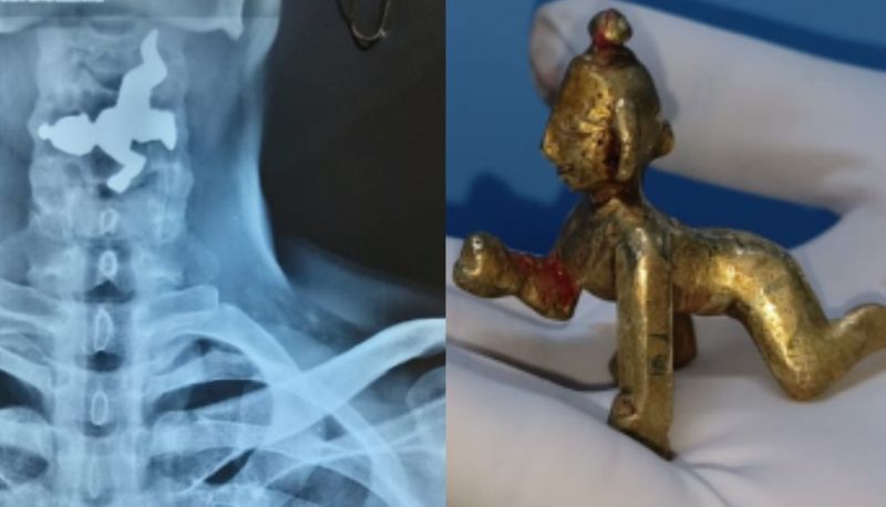 Belagavi doctors remove small Krishna idol swallowed by man during pooja mnj 