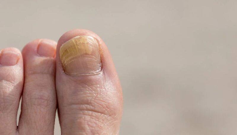 Are you a toenail sufferer? These tips are for you!