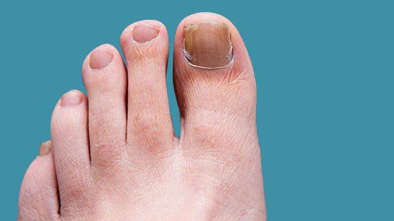 Are you a toenail sufferer? These tips are for you!