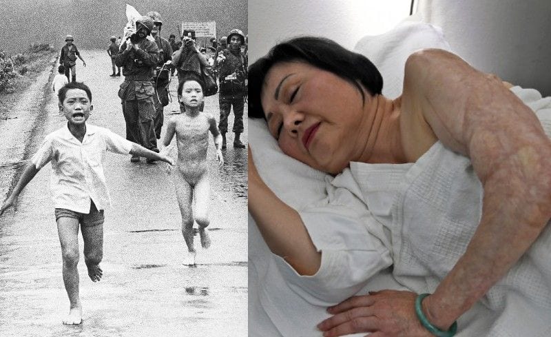 Napalm Girl gets final burn treatment in US 50 years later 