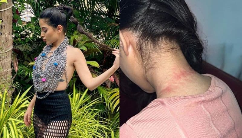 bigg boss ott star urfi javed shares photo of her injury after wearing to made of chains 