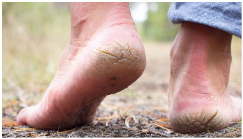 How to heal cracked feet overnight rsl