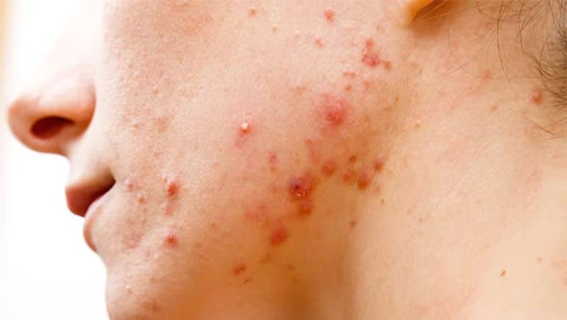 Tips to Combat Acne and pimples 