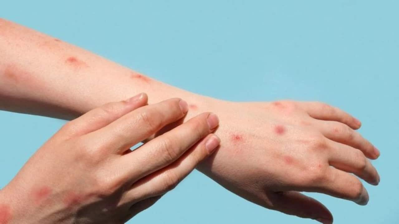 Another monkeypox case reported in Kerala, 3rd case in India; SOPs issued