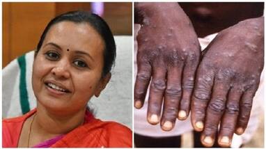 The second positive case of Monkey Pox in Kerala has been confirmed in Kannur District san The second positive case of Monkey Pox in Kerala has been confirmed in Kannur District san