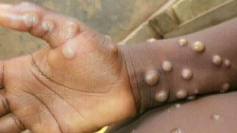 youth from kerala dies of monkey pox 