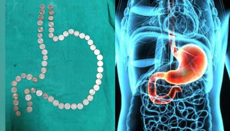 Doctors remove 50 Coins From Rajasthan Man's Stomach without surgery