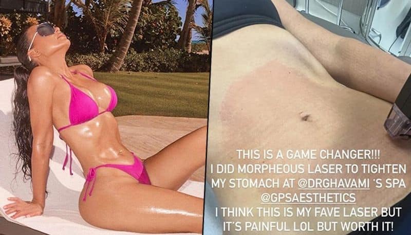 SCARY Pictures: Kim Kardashian gets painful 'Morpheus Laser Treatment' to get curvy, sexy figure RBA