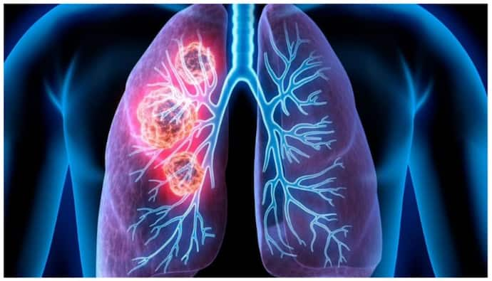 lung cancer