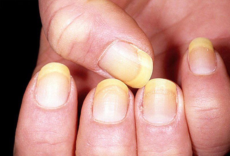 Lung cancer Don't ignore this symptom in your nails