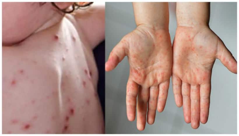 Tomato flu: Centre's new advisory says maintain proper hygiene, use warm water & more