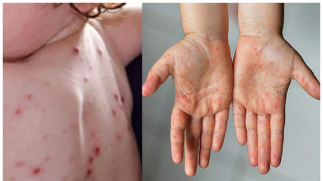 Tomato flu: Centre's new advisory says maintain proper hygiene, use warm water & more